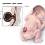 spina-bifida (4)