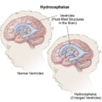 hidrocefalus (6)