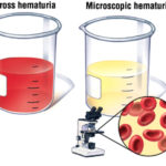 hematurija (5)