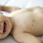 Crying baby girl with measles