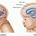 Hydrocephalus