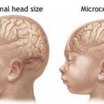 microcephaly
