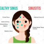 sinusi-infekcija
