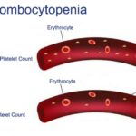 Trombocitopenia