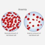 anemija (4)