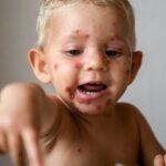 impetigo