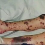 meningokokna-infekcija (6)