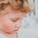 dermatitis (2)