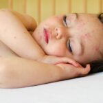 Child with chicken pox
