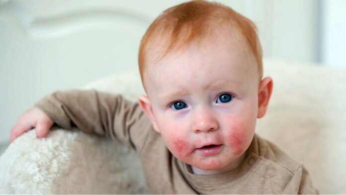 atopicen-dermatitis