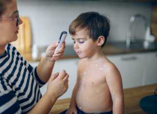 ПЕДИЈАТРИТЕ УКАЖУВААТ: Првите симптоми на овчи сипаници често поминуваат незабележани