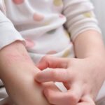 Стресот од детството го зголемува ризикот од појава на псоријаза