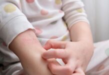 Стресот од детството го зголемува ризикот од појава на псоријаза