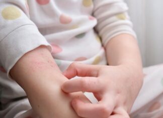 Стресот од детството го зголемува ризикот од појава на псоријаза