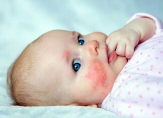 Специјалистите за алергии од „Џон Хопкинс“ советуваат: КАКО ДА ГИ ПРЕПОЗНАЕТЕ И ДА СЕ СПРАВИТЕ СО АЛЕРГИСКИТЕ РЕАКЦИИ КАЈ ДЕЦАТА