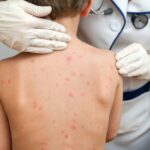 ШТО СЕ КРИЕ ЗАД ДЕТСКИОТ ОСИП: Од овчи сипаници до петта болест – водич за бактериски и вирусни заболувања