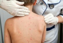 ШТО СЕ КРИЕ ЗАД ДЕТСКИОТ ОСИП: Од овчи сипаници до петта болест – водич за бактериски и вирусни заболувања