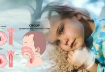 ДАЛИ КРУПОТ Е ЗАРАЗЕН? Најчесто ги погодува малите деца на возраст меѓу шест месеци и три години