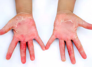 СИНДРОМ НА ТОКСИЧЕН ШОК КАЈ ДЕЦА: Ретка, но животозагрозувачка состојба што бара итна лекарска помош