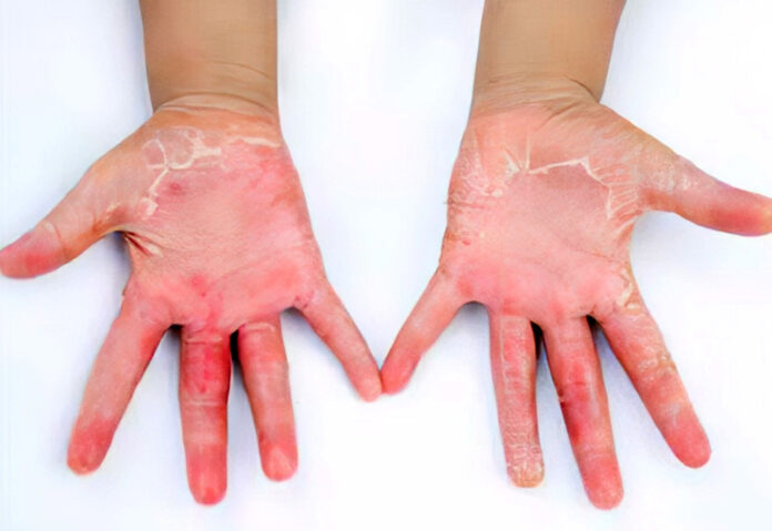 toksicen-sok-sindrom