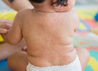 Осип по температура кај деца: Кога е нормална појава, а кога аларм?